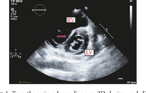 d shaped lv cavity|d shaped left ventricle function.